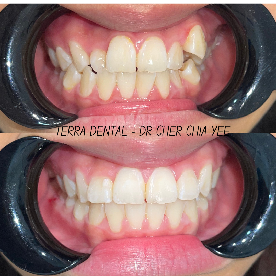 Smile transformation